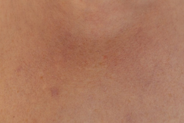 De oorzaak van rosacea