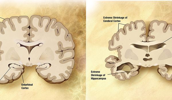 Dementie 2050: Vlaardingen 1 op de 9 senioren, Schiedam 1 op de 10